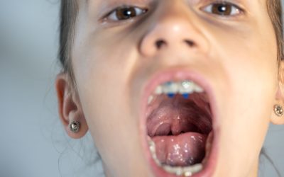 Tonsilliti nel bambino: quando le “sentinelle” della gola si ammalano